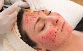 Three people in New Mexico who received "vampire facials" were HIV positive