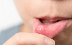 7 Natural Home Remedies to Cure Mouth Ulcers Effective Solutions for Quick Relief