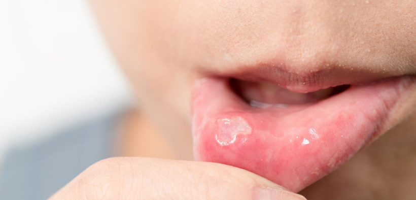 7 Natural Home Remedies to Cure Mouth Ulcers Effective Solutions for Quick Relief