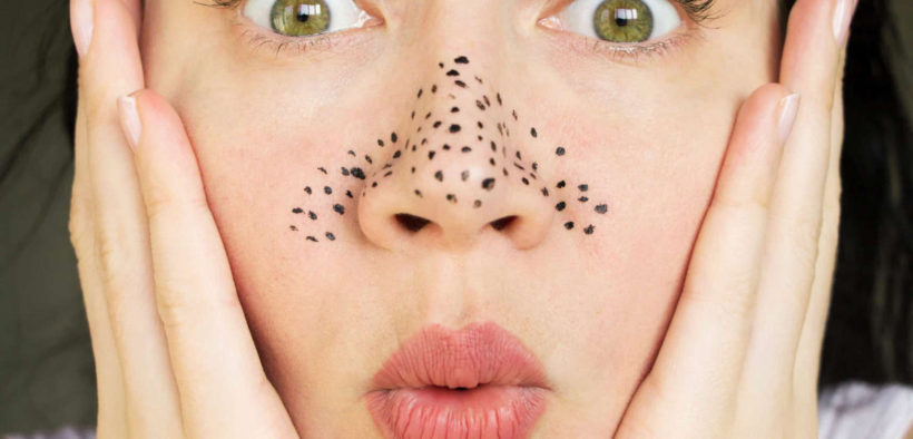 The best and worst ways to remove blackheads