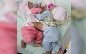 Successful Twin Delivery in Karachi After Collaborative Surgery